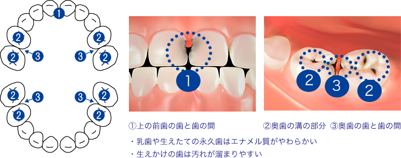 子供がむし歯(虫歯)になりやすい部分