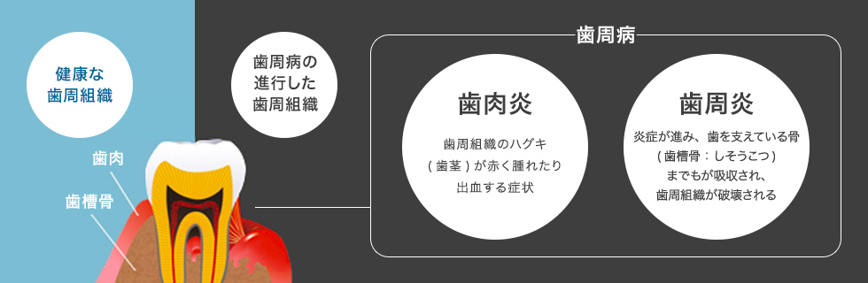 健康な歯周組織 歯周病の進行した歯周組織