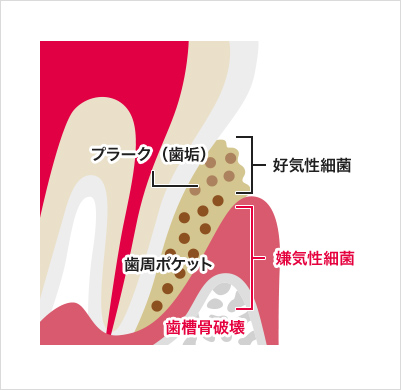 歯周病の原因