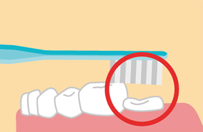 生えてくる途中の歯は他の歯より低いため、ハブラシの毛先が届いていないことがある。