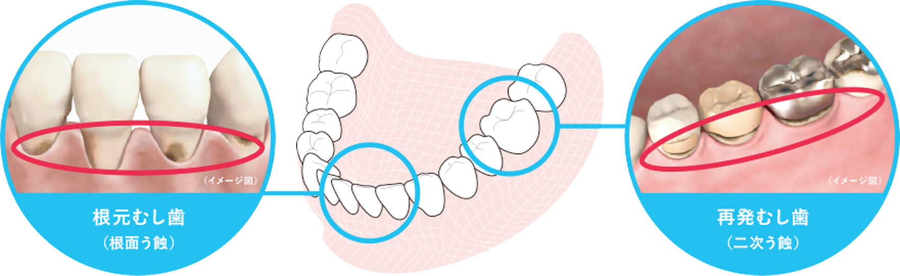 根元むし歯(根面う蝕)、再発むし歯(二次う蝕)