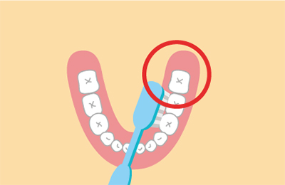 歯の噛み合わせ部分はハブラシが届きにくく、むし歯(虫歯)になる確率が高い。